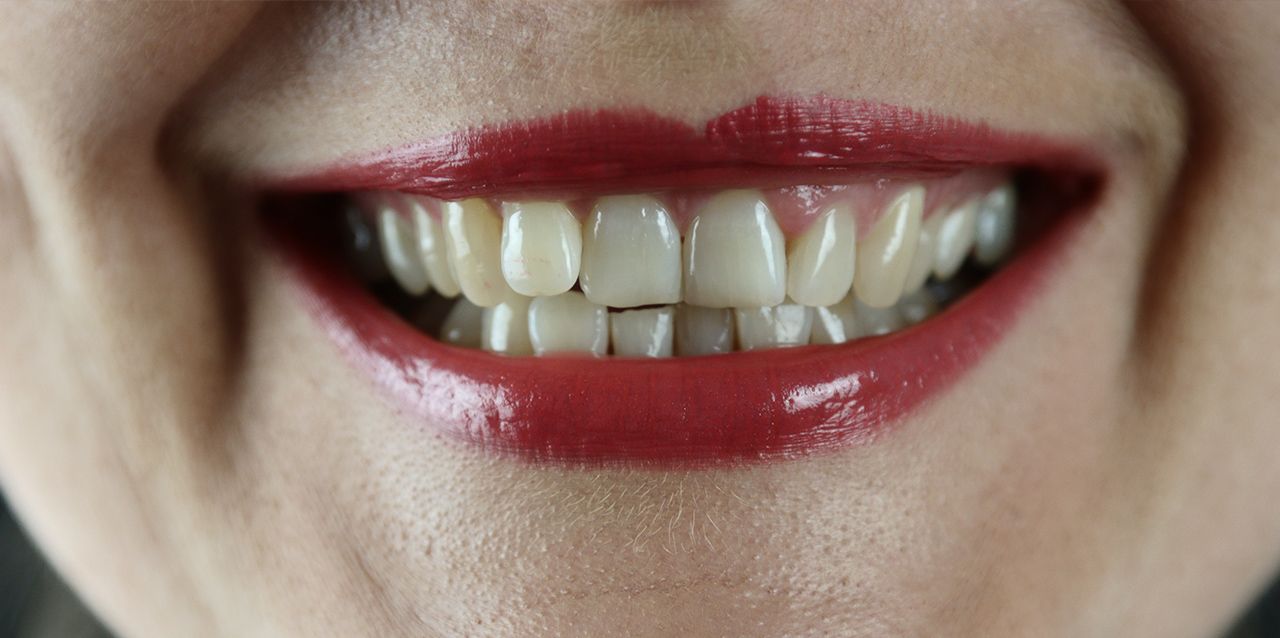 dientes en sonrisa